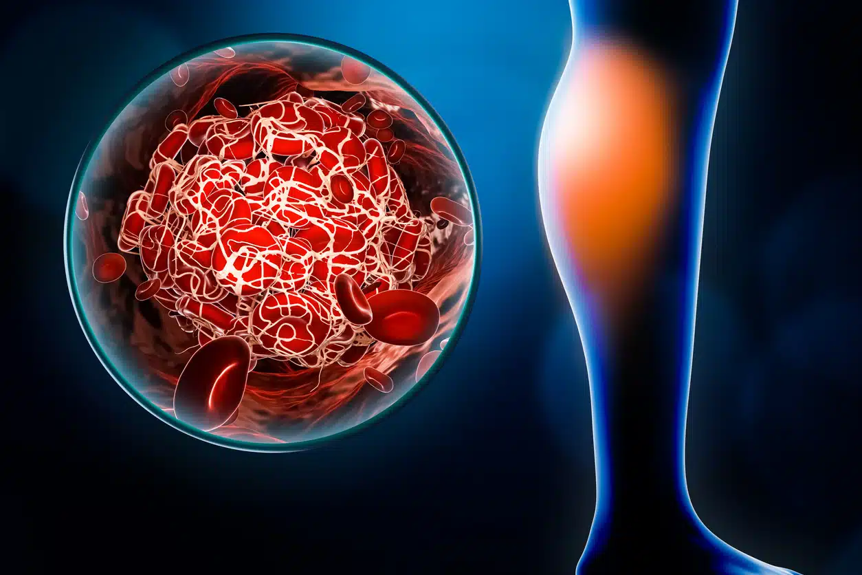 Blood clots in legs; Arterial embolism or embolus located in the calf