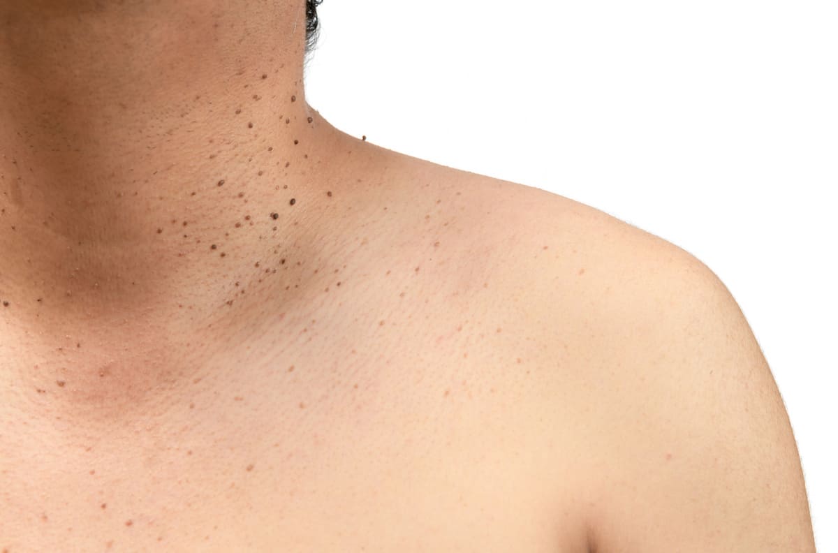 how to remove skin tags on neck how to remove skin tags on neck