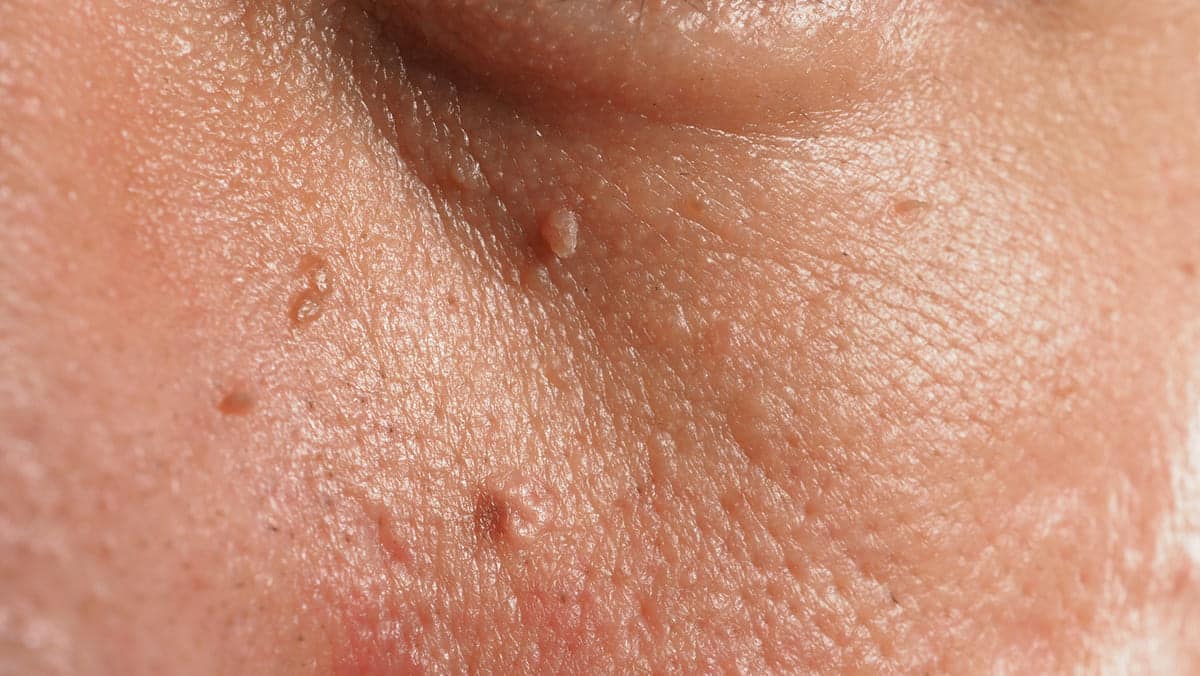 small warts or skintags by eye