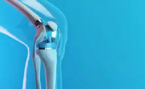 Knee Replacement