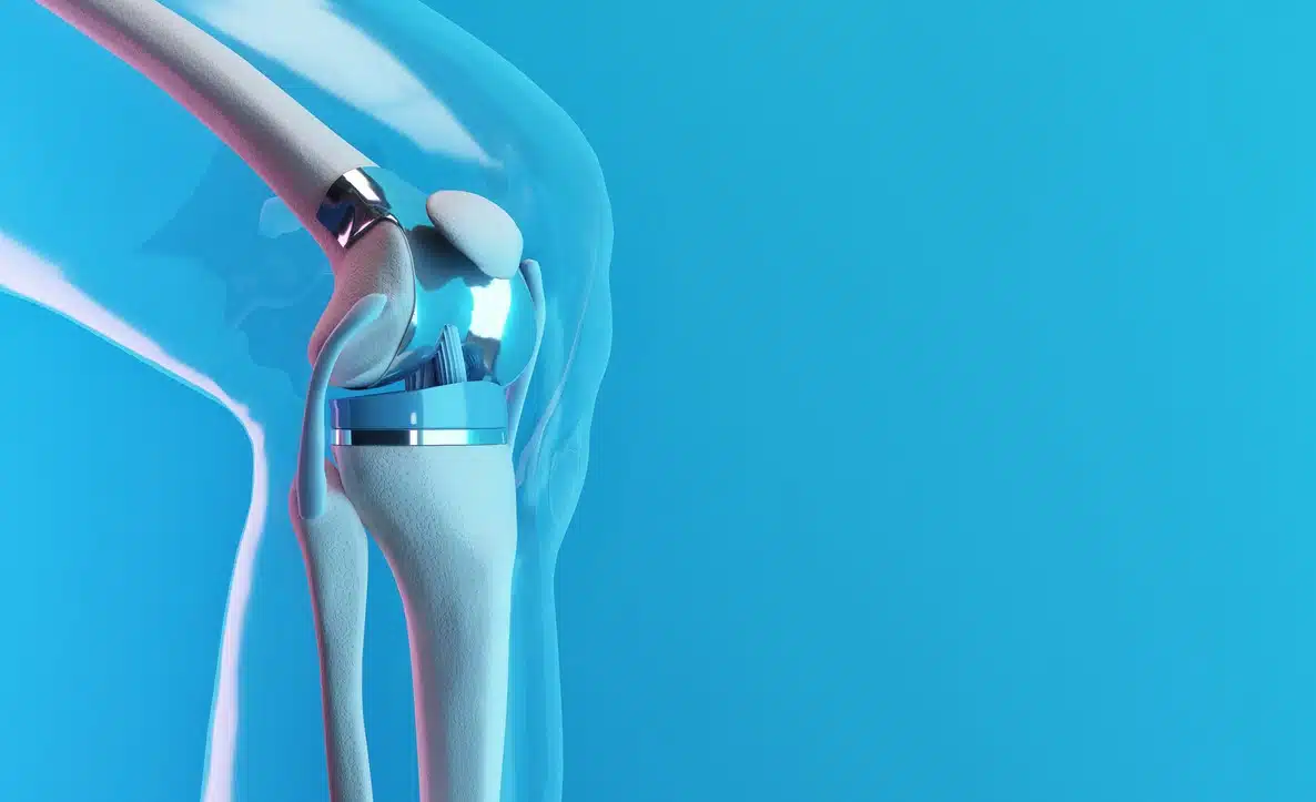 Knee Replacement