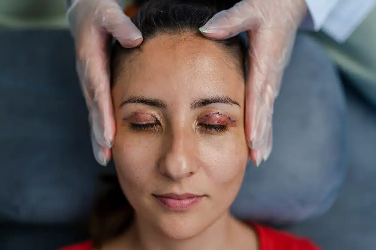 Upper-Eyelid Blepharoplasty