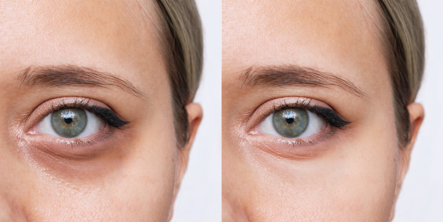 Considering Under-Eye Filler? Here's What You Should Know | SELF