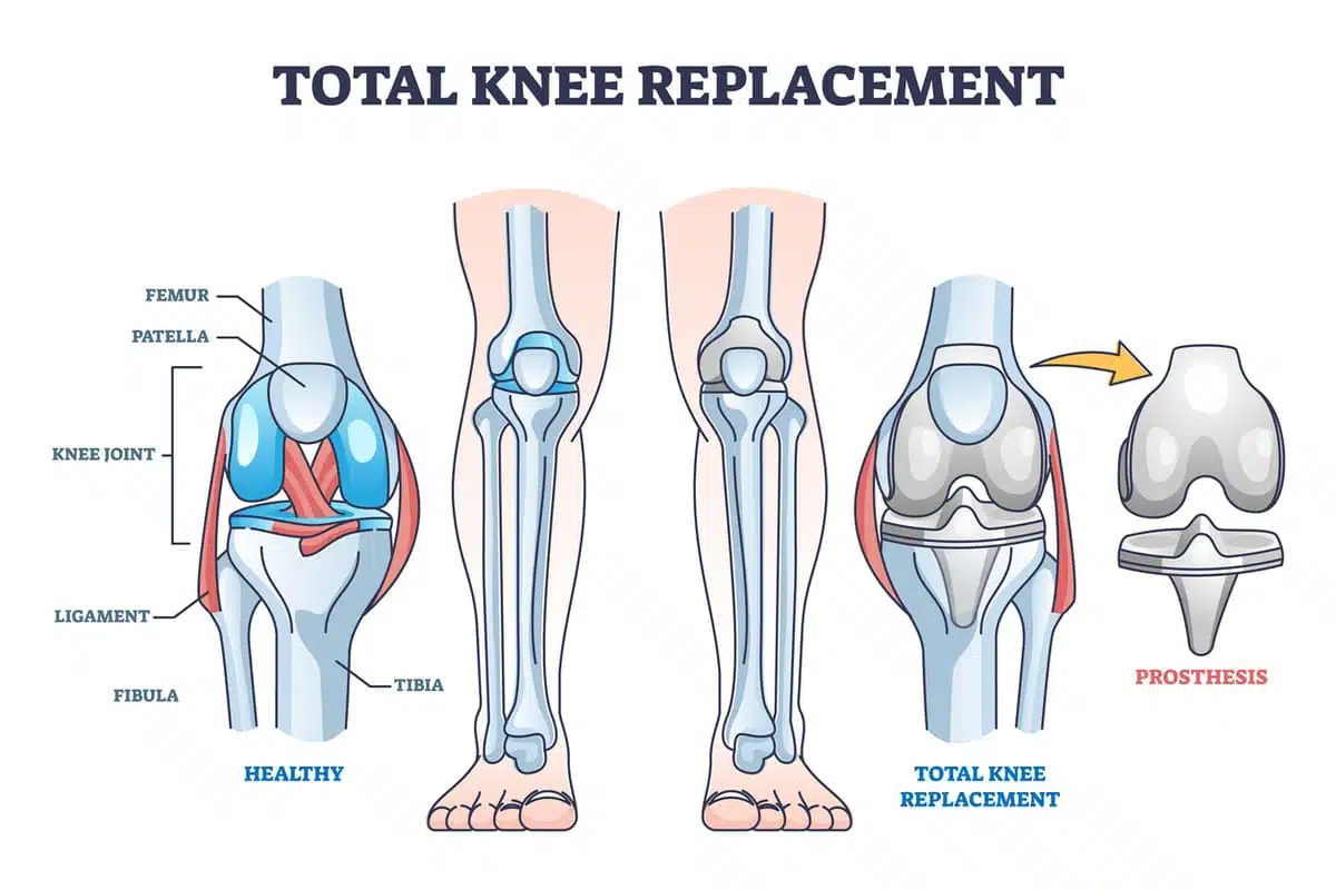 total knee replacement graphic