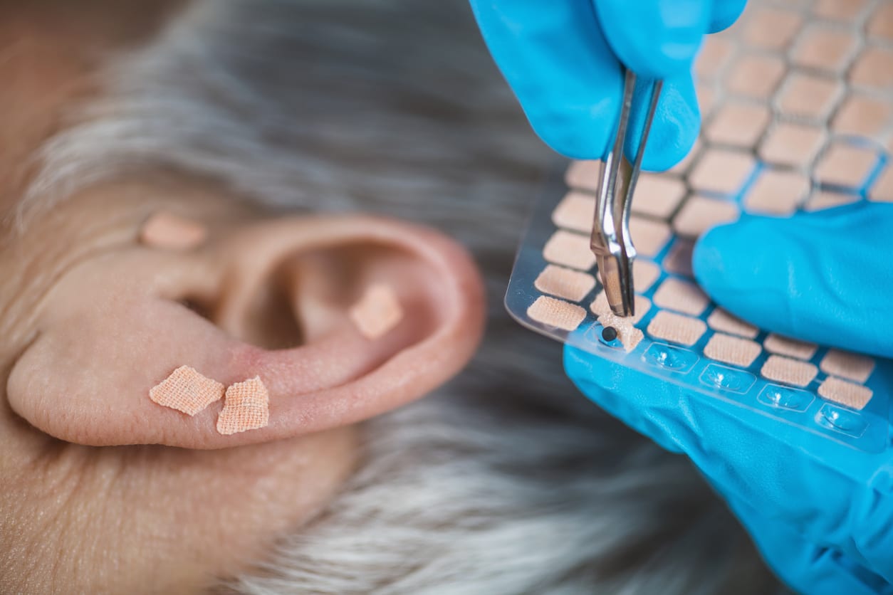 Auriculotherapy on human ear