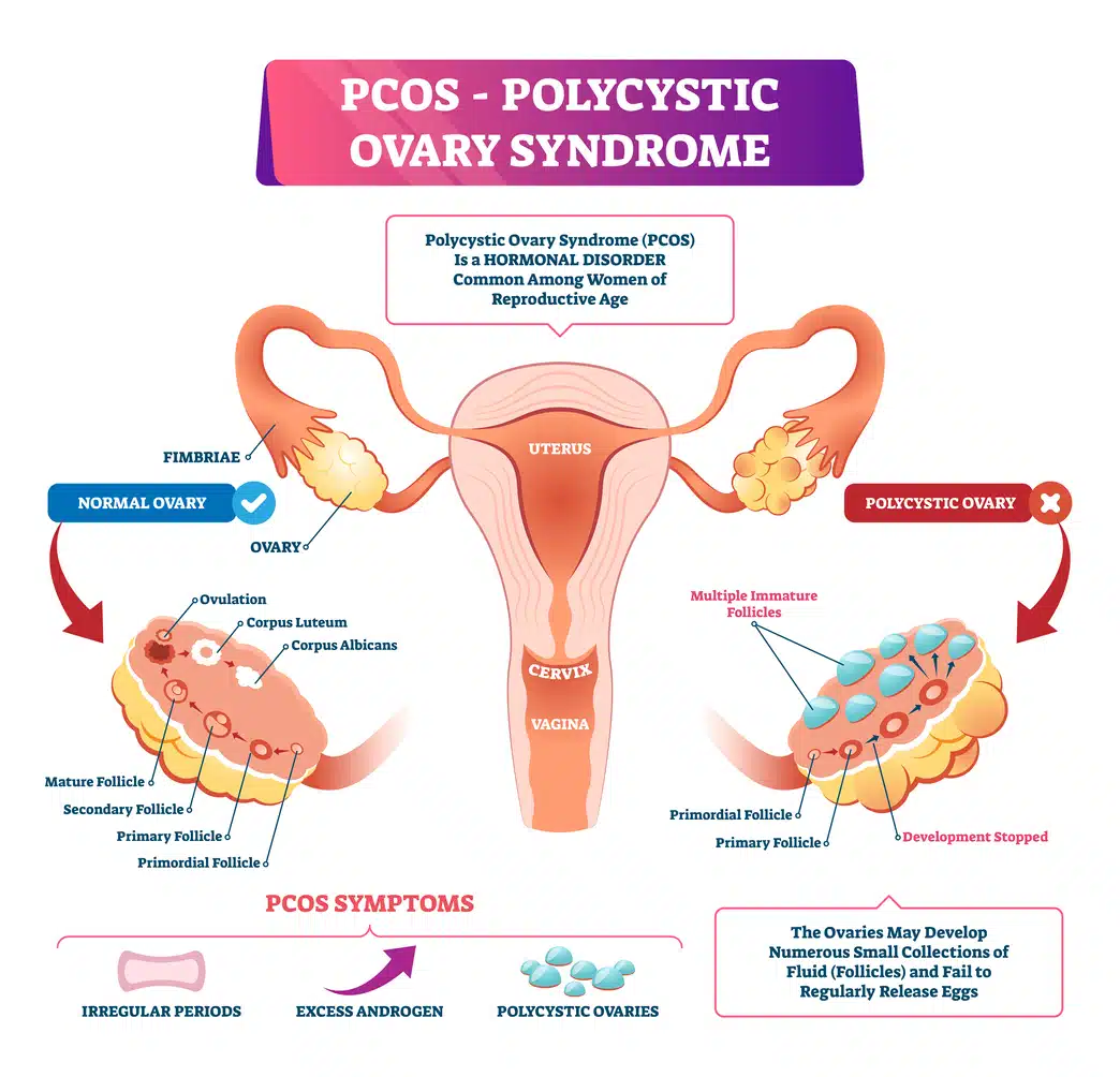 Polycystic ovary syndrome or PCOS vector illustration. Labeled internal reproductive disease comparison scheme with healthy and sick female organs. Set of anatomical symptoms due to elevated androgens