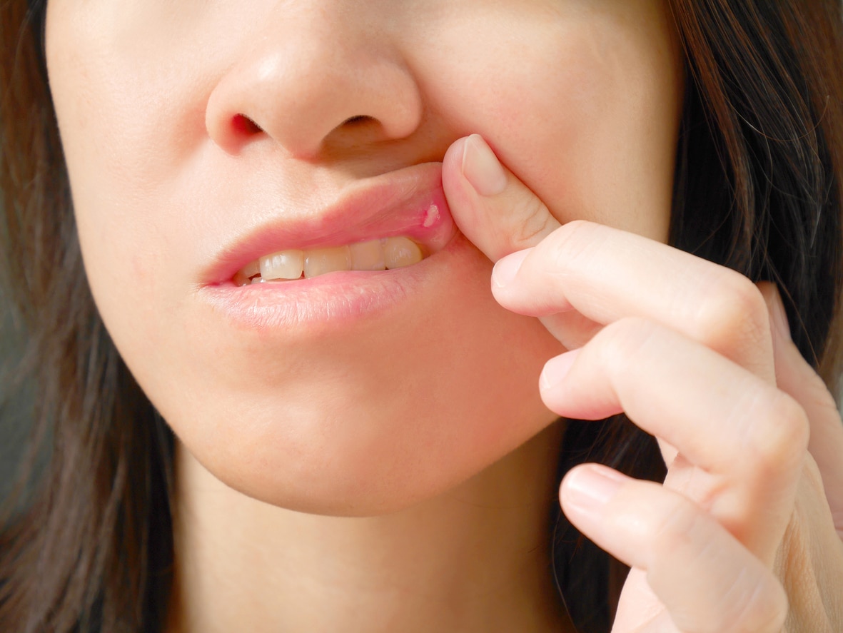 Canker sore, mouth ulcers