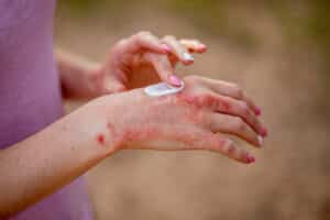 Eczema treatments on the hands, dry, itchy skin, psoriasis