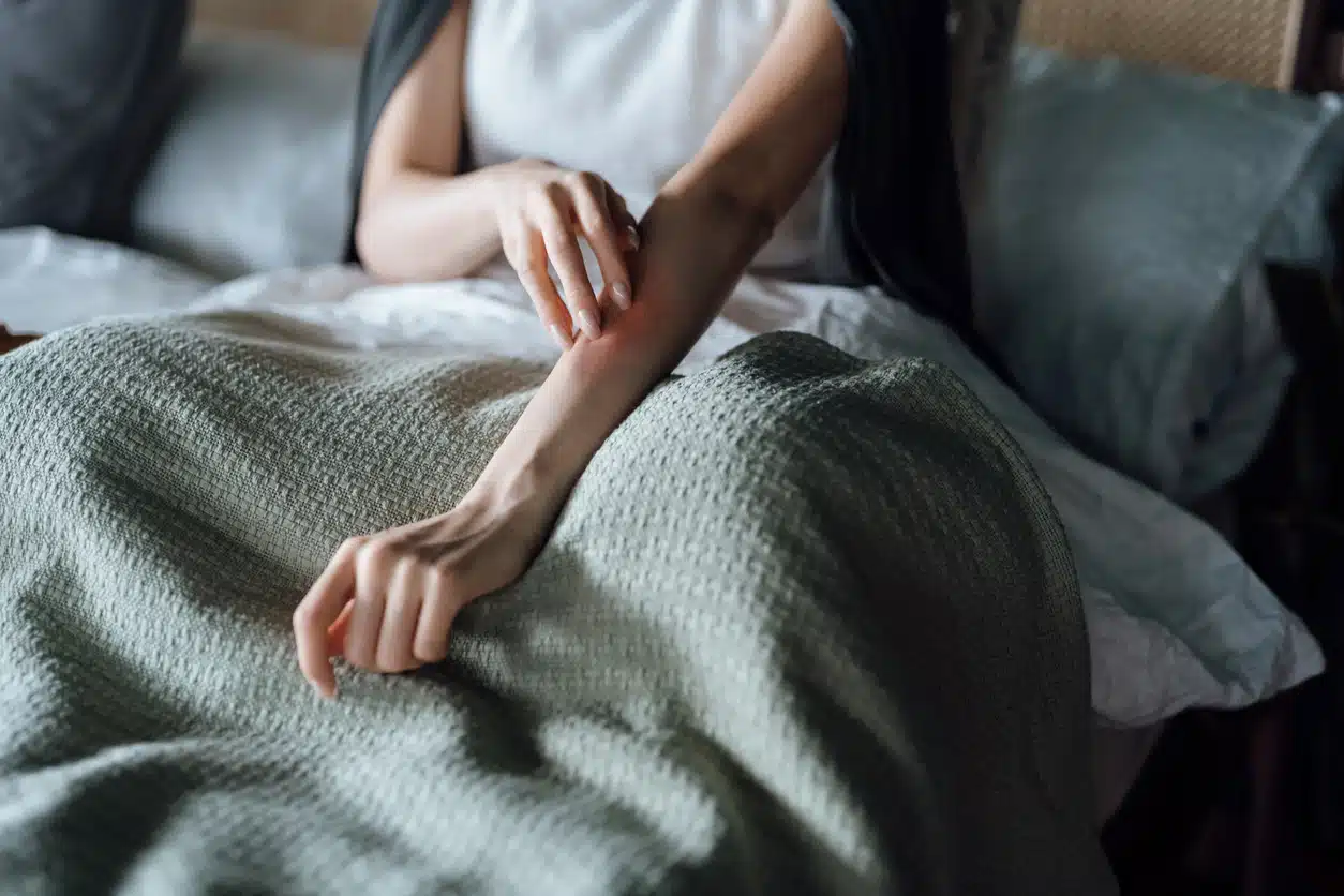 Eczema treatments on the elbow, dry, itchy skin, psoriasis 