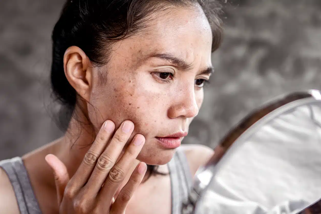Asian woman having skin problem checking her face with dark spot, freckle from UV light in mirror