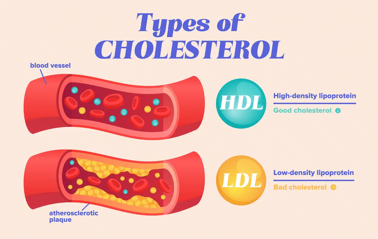 Types of cholesterol comparison with HDL and LDL lipoprotein. Labeled educational normal and narrowed artery cross section explanation. Physiological high fat diet problem example. Vector illustration