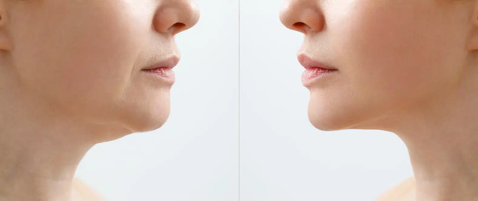 A close portrait of an aged woman before and after facial rejuvenation procedure. Correction of the chin shape liposuction of the neck. The result of the procedure in the clinic of cosmetic medicine
