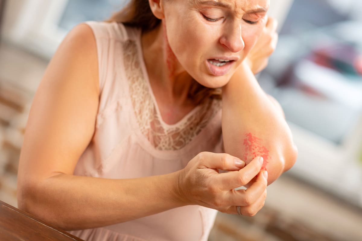 Woman with a rash on her elbow