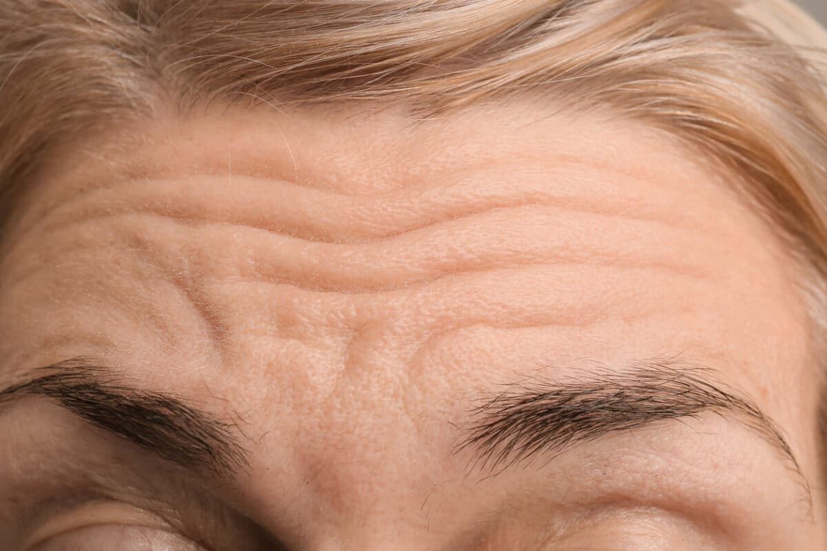 Forehead wrinkles