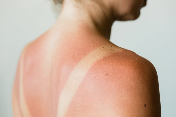 woman with a sunburn