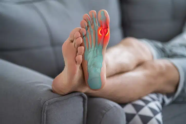 Gout attack in foot, painful joints