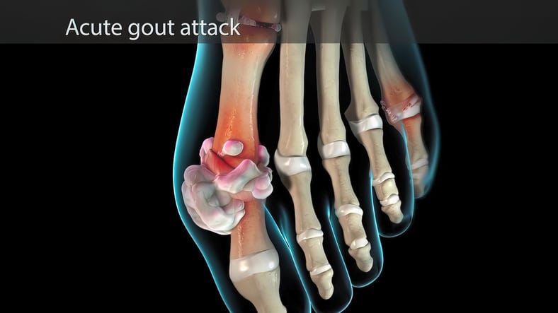 Acute gout attack