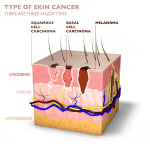 Basal Cell