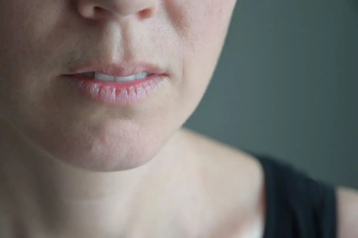 Dry, chapped lips