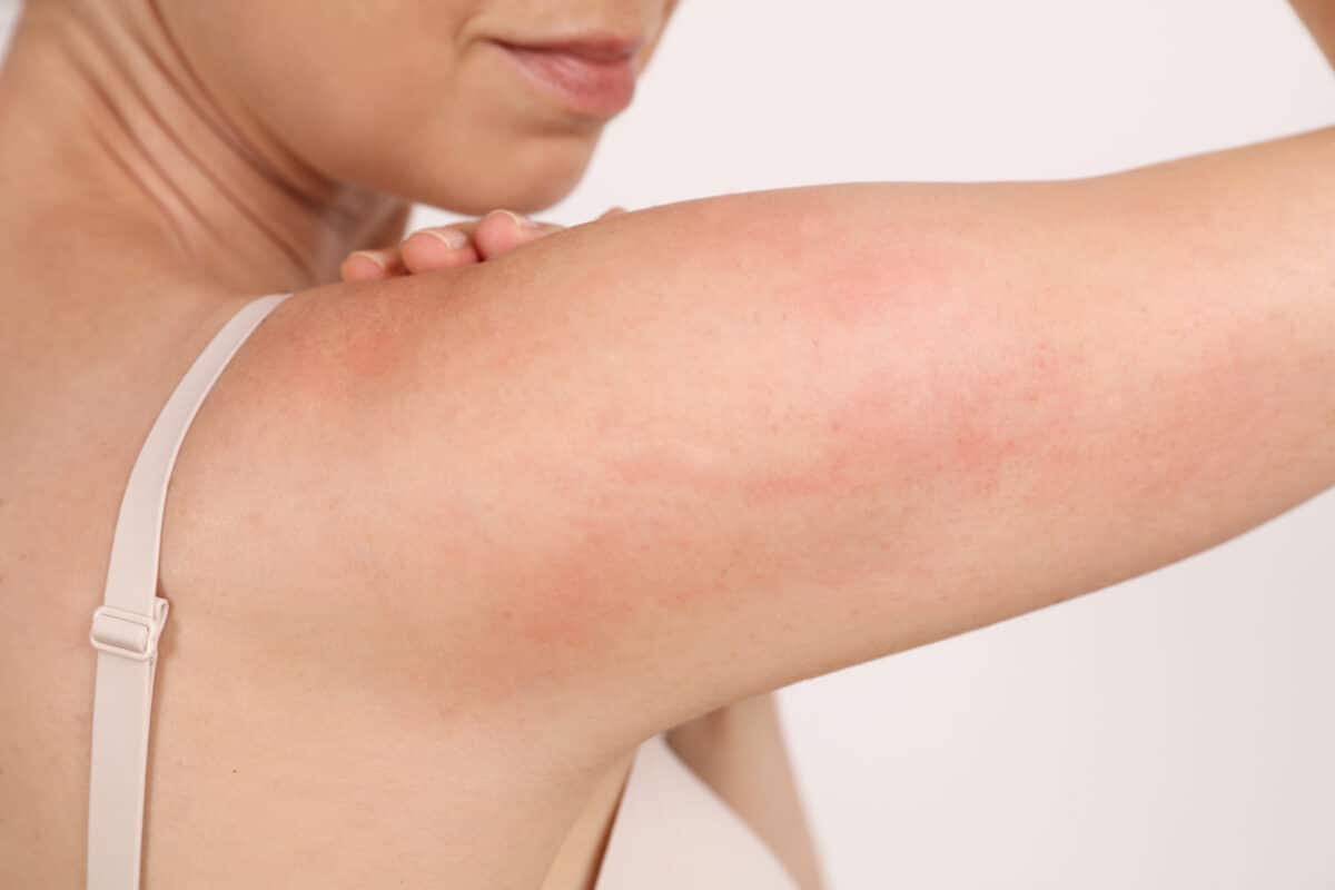 Dry red skin on arms