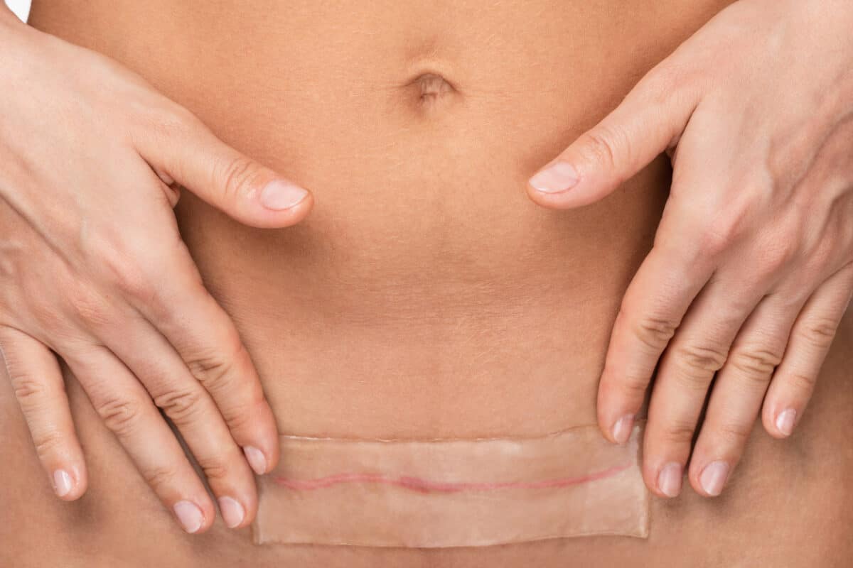 Woman is applying patch with a silicone sheeting on her scar after C-section surgery.
