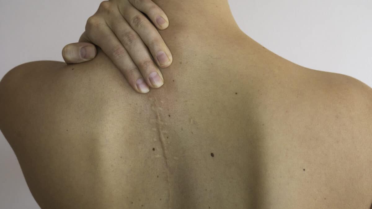 Caucasian woman's upper back with a scar.
