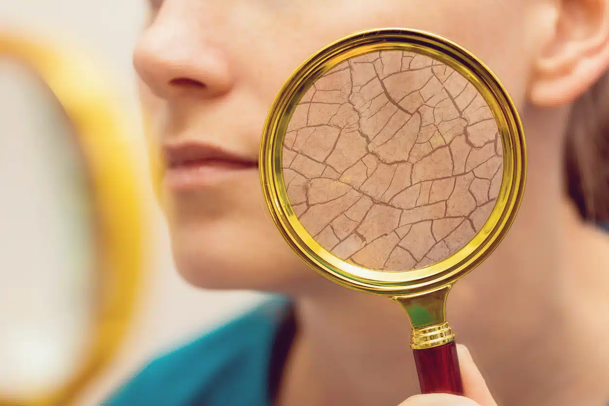 Managing dry skin