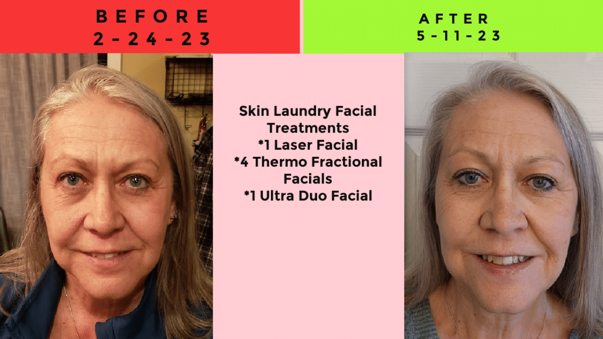 Diana Rowe Before and After Thermo-Fractional facial