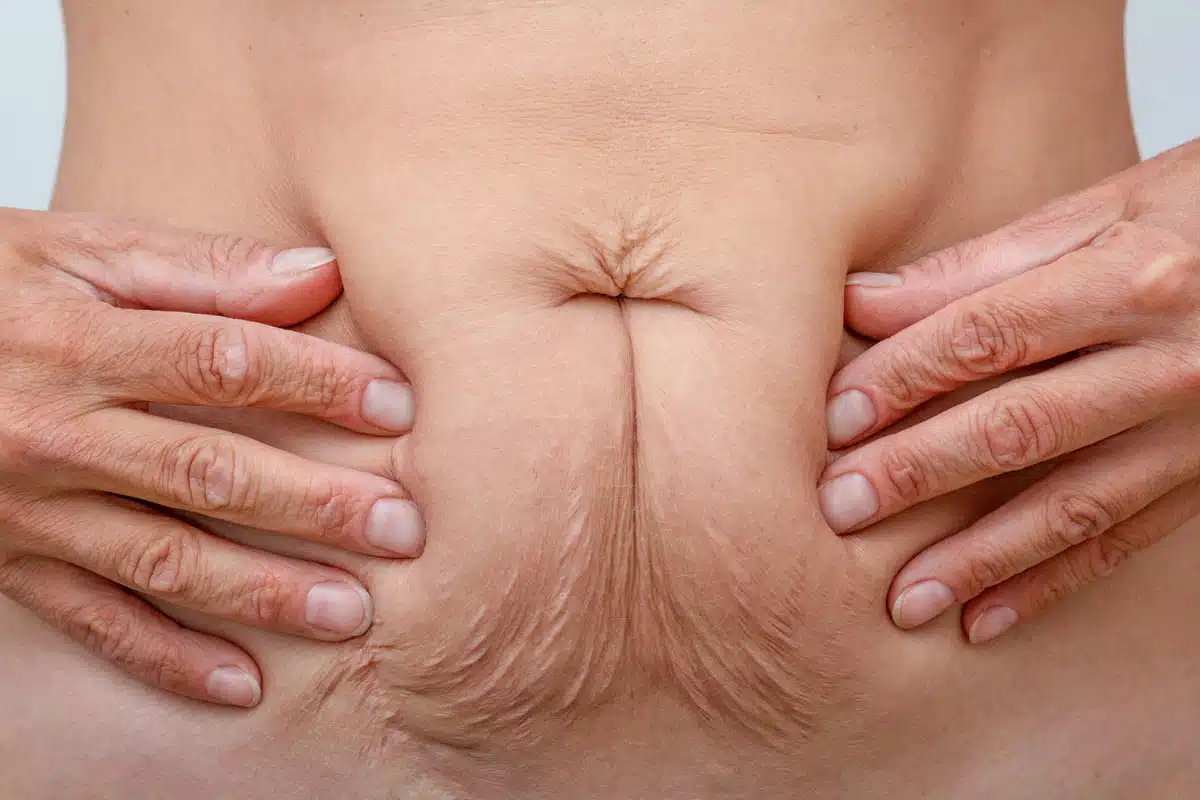 Loose skin on stomach