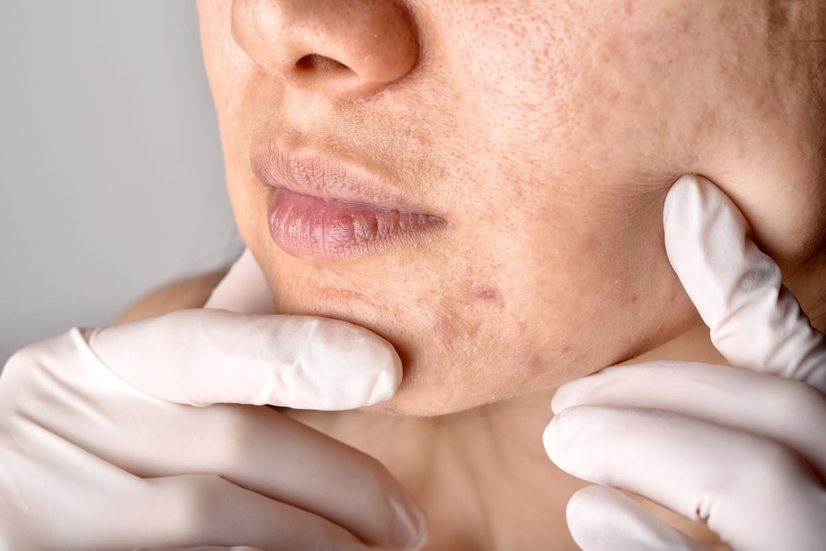 doctor looking at acne scars
