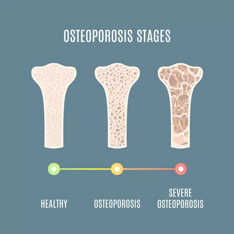 stages of osteoporosis