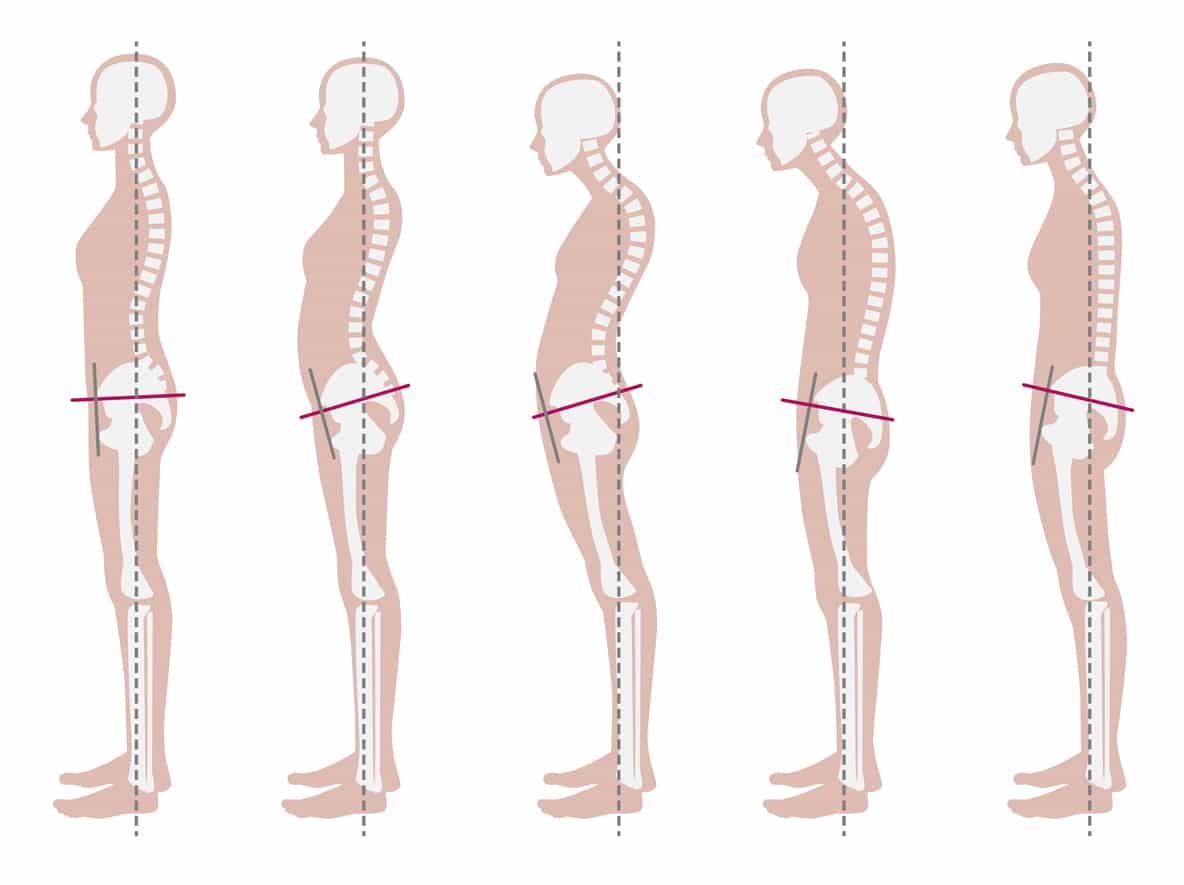 Skeletal sample of good and bad posture
