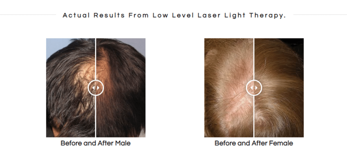 Mayraki Hair Regrowth Ulti-Nutra Laser System before and after