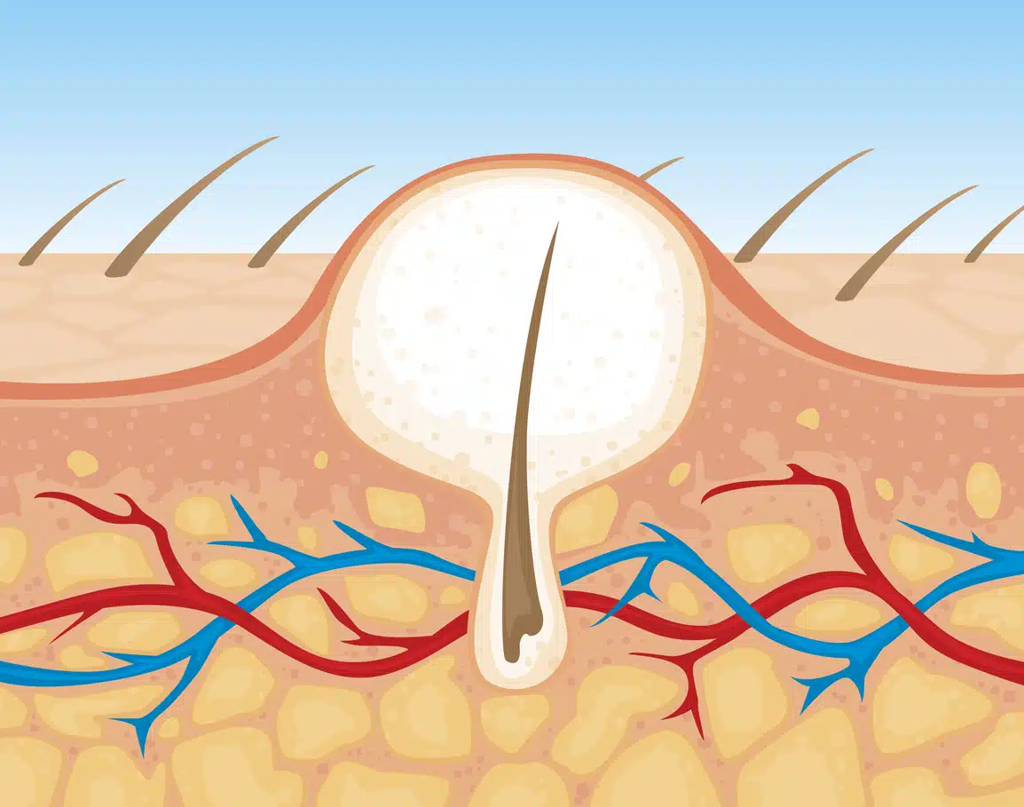Diagram of an ingrown hair