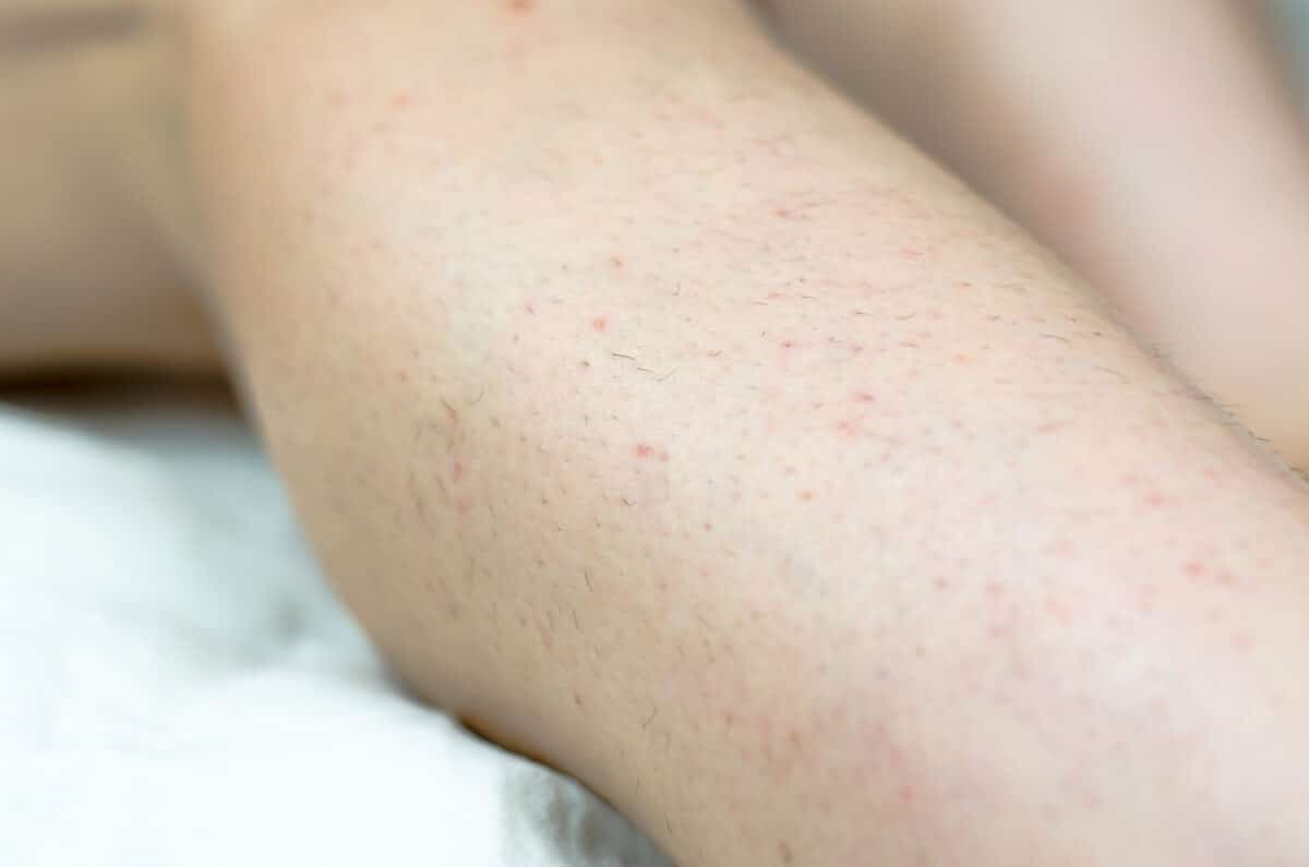 Ingrown hairs on legs