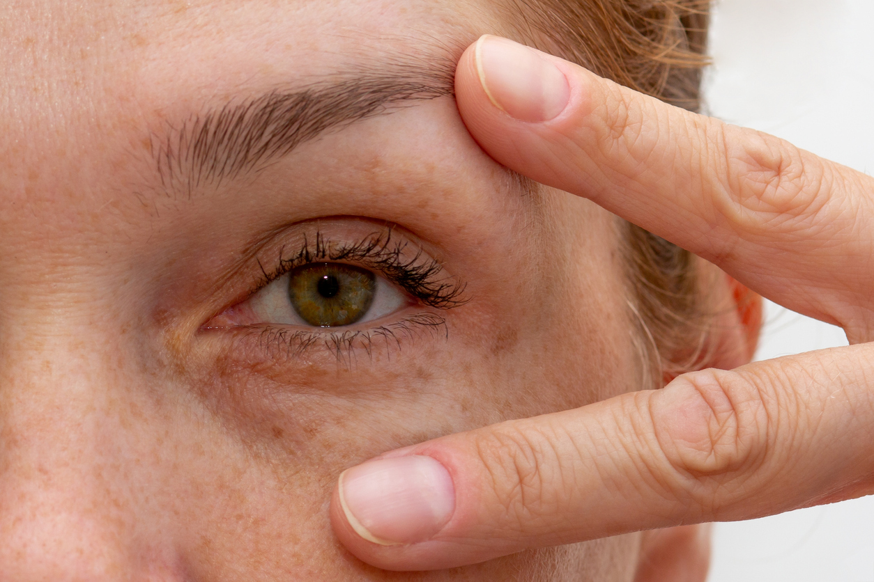 Droopy eyelid, eyelid surgery