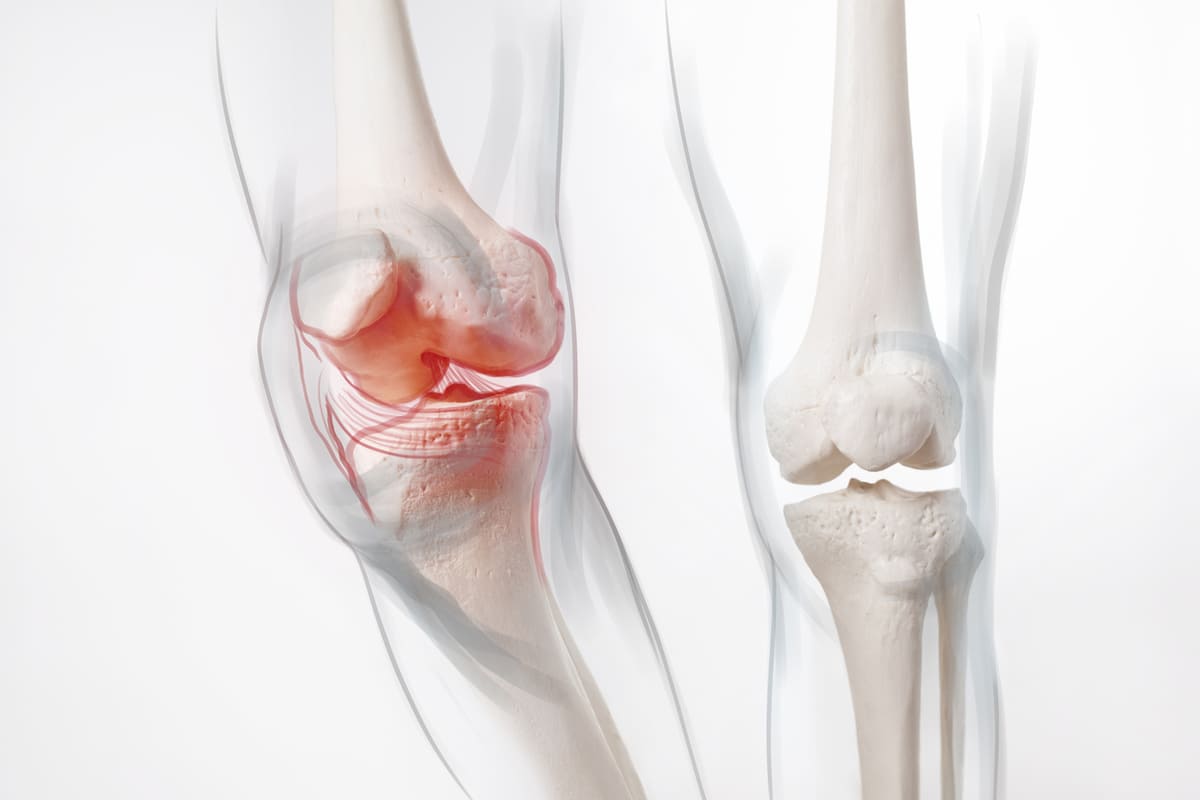 knee inflammation
