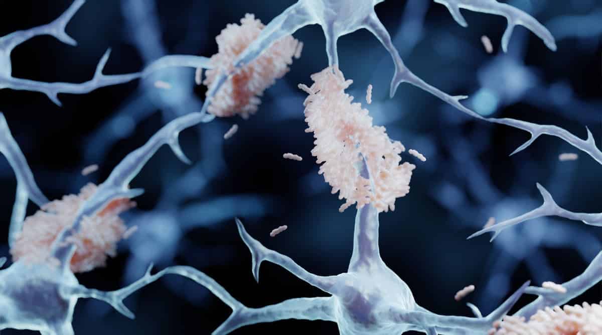 amyloid plaques in alzheimers disease