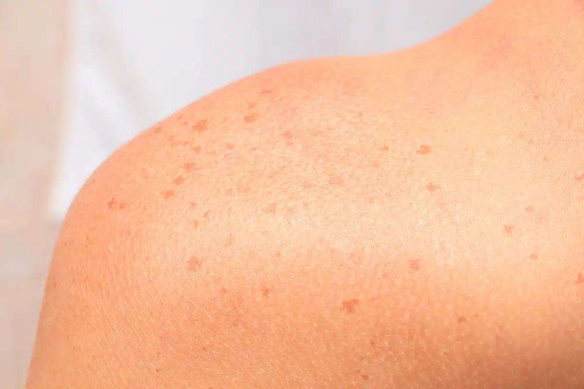 sun spots