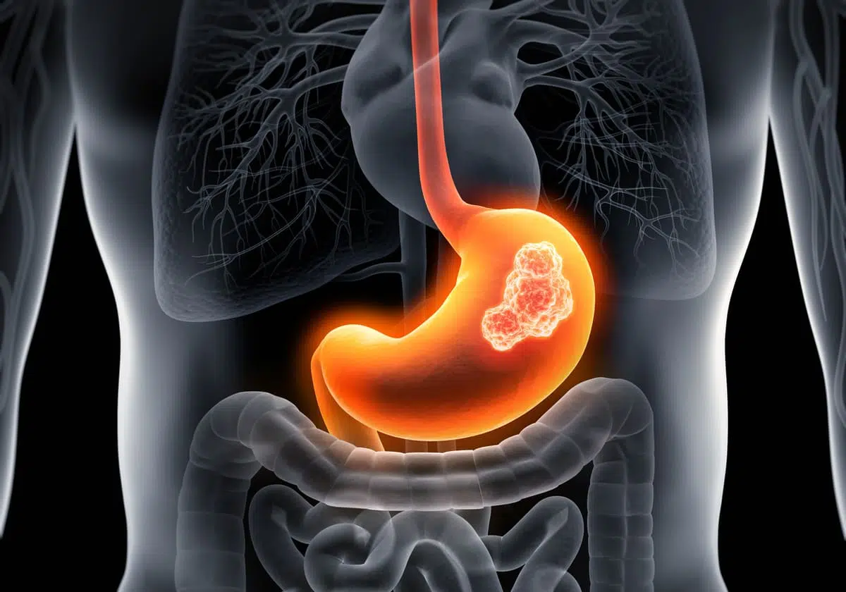 Body with stomach tumor