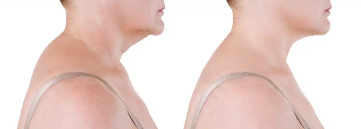 neck hump, hunchback, hunched neck, neck pain