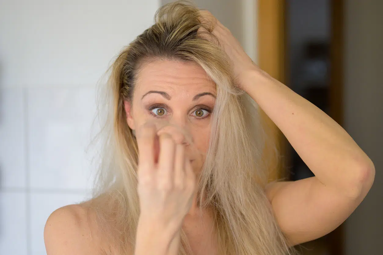 Thinning Hair, hair loss