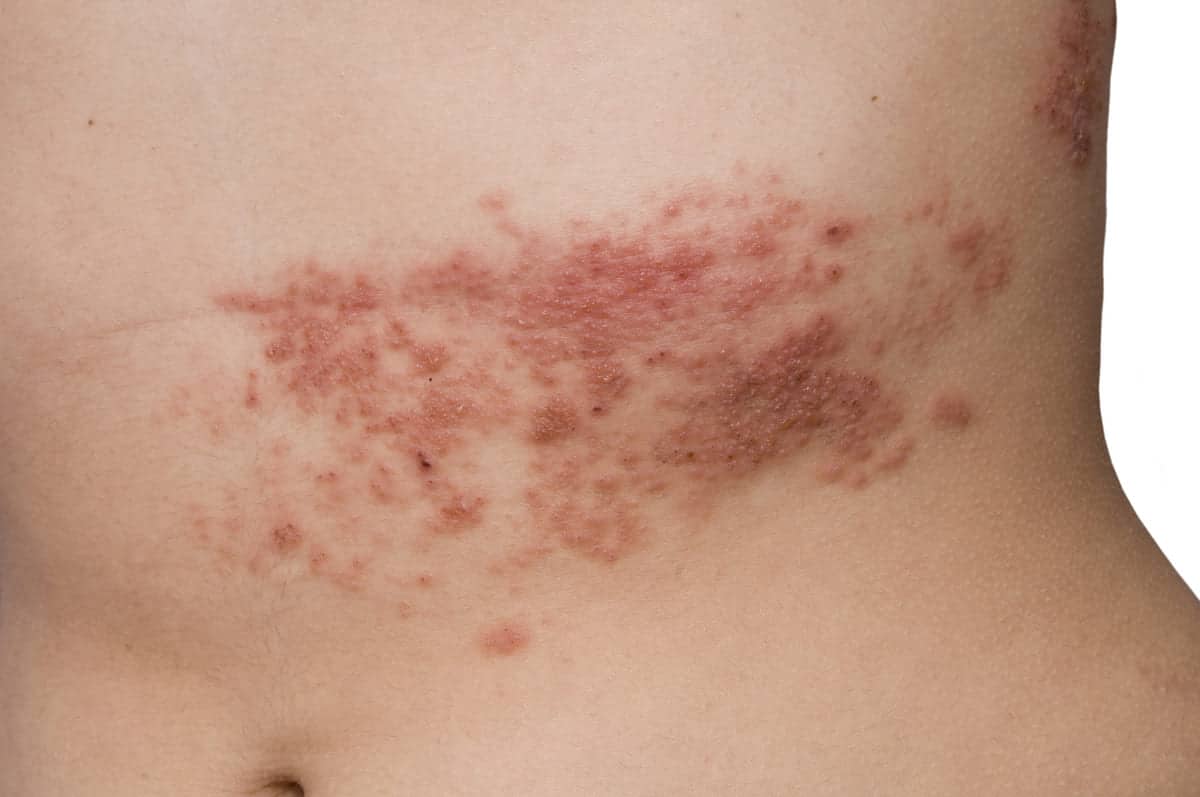 shingles on stomach