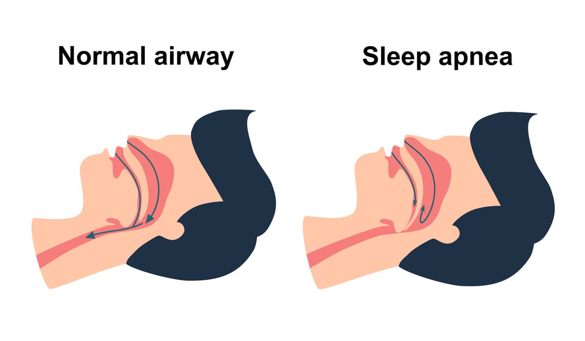 sleep apnea