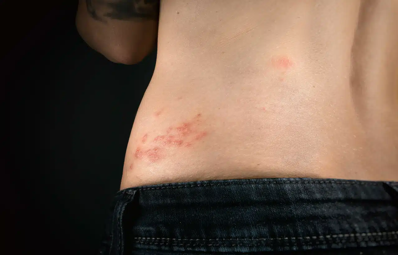 Woman with shingles on her torso