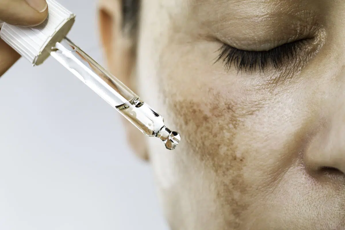 Hyperpigmentation, dark spot, glycolic acid serum