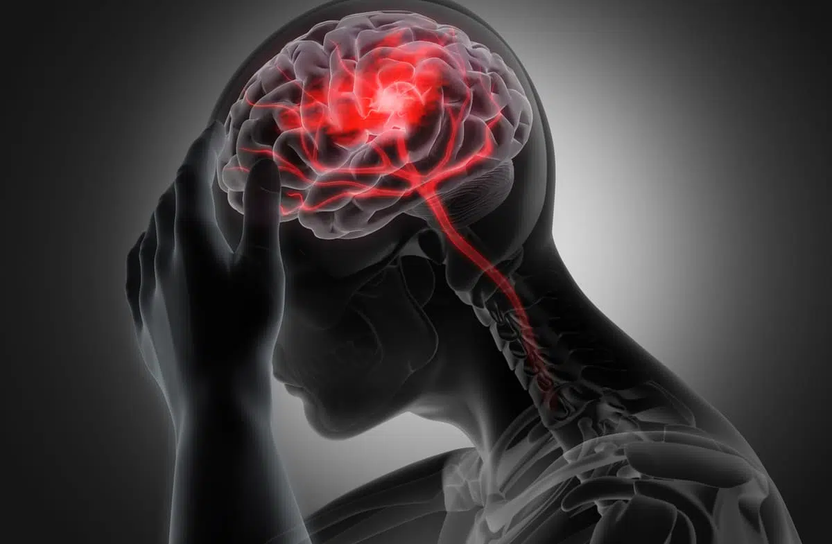 migraine illustration