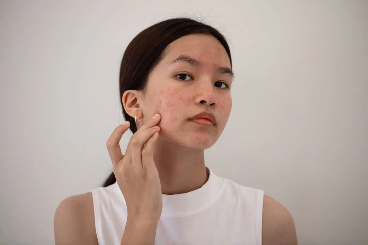 woman with acne