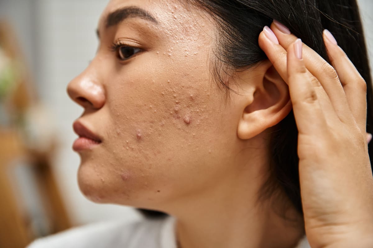 Woman with acne