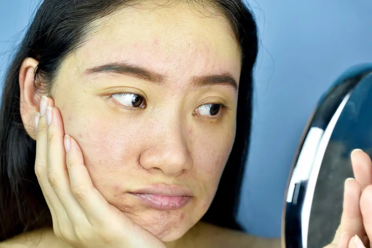 Dry skin